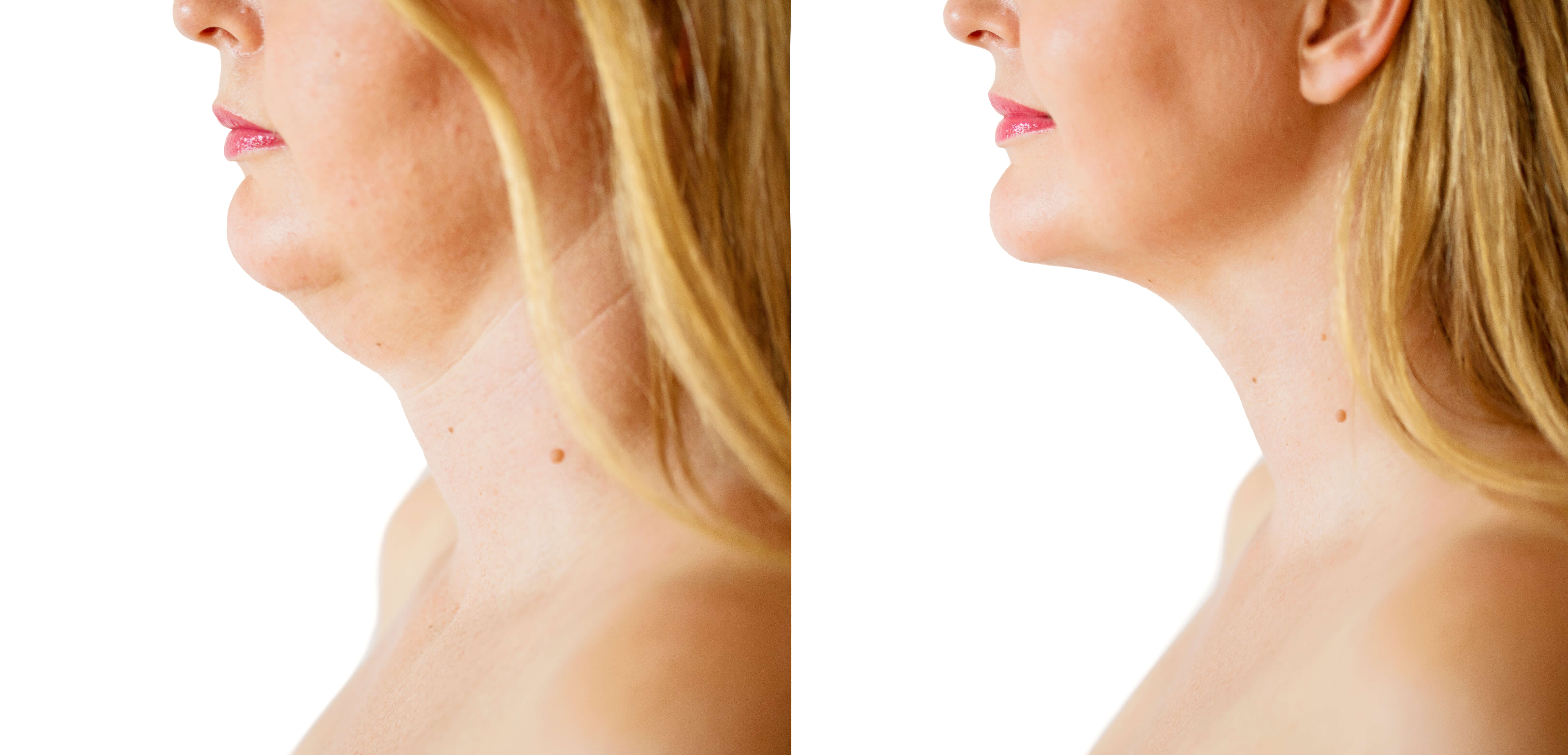 female necklift NYC and long island