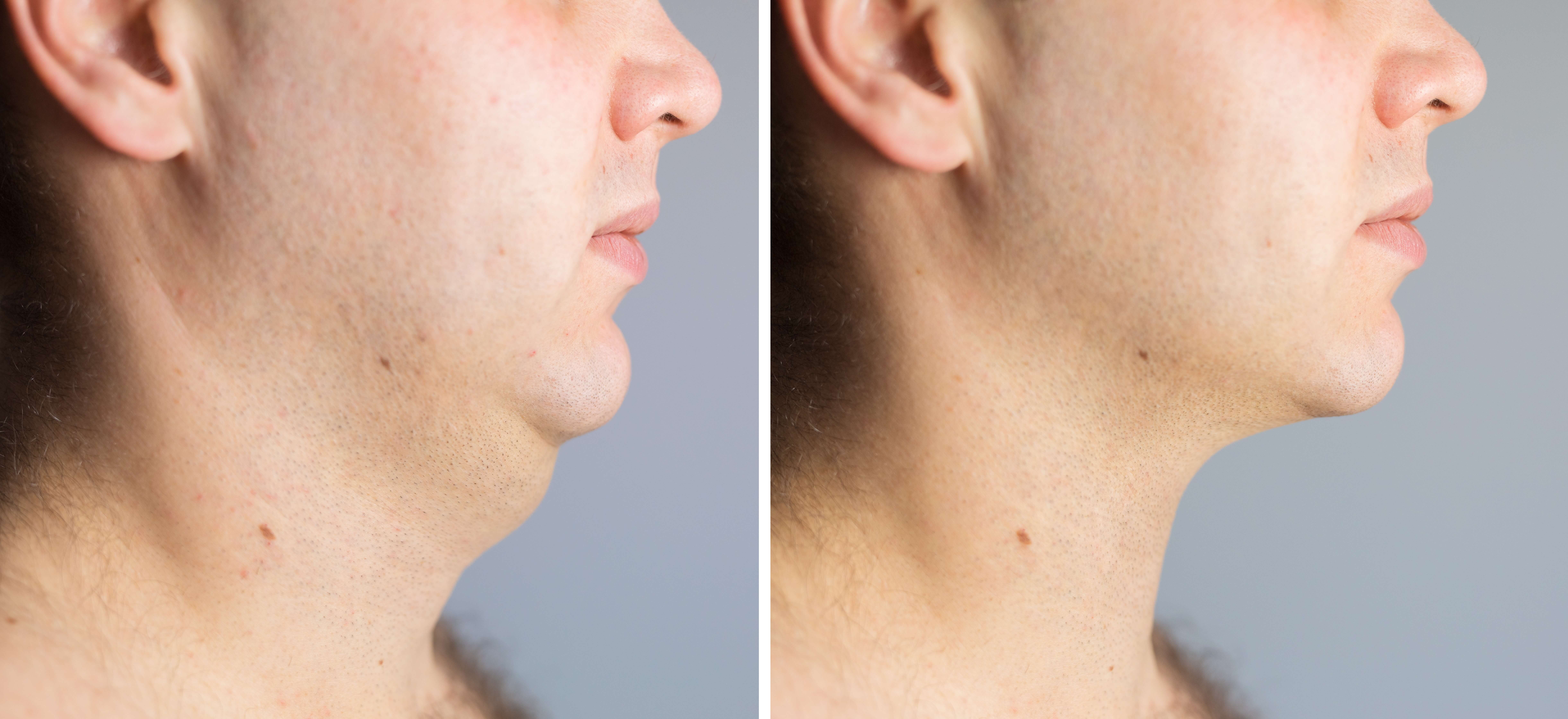 male necklift NYC and long island