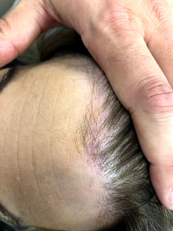 osteoma of forehead, endoscopic, hidden scar