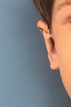 Prominent ears are an inherited problem that can be corrected with an appliance for ear molding or through surgery.