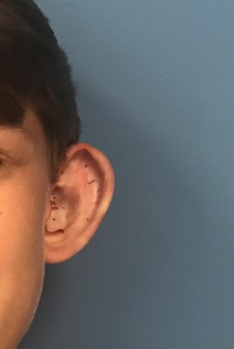 Prominent ears are an inherited problem that can be corrected with an appliance for ear molding or through surgery.