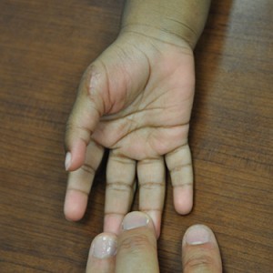 Dr. Bastidas has much experience in surgical reconstruction of extra fingers & toes, resulting in patient satisfaction.