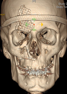 Dr. Nicholas Bastidas is a renowned surgeon dealing with nasal, ZMC, orbital floor and mandible fractures.