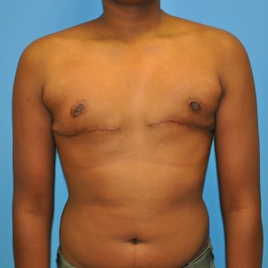 Male breast enlargement may occur soon after puberty as a result of the imbalance of estrogen and testosterone.