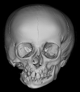 The protocol for treating hemifacial microsomia is a series of surgeries to address its various characteristics.