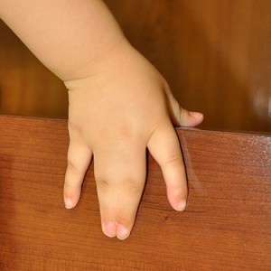 Dr. Bastidas has much experience in surgical reconstruction of webbed fingers & toes, resulting in patient satisfaction.