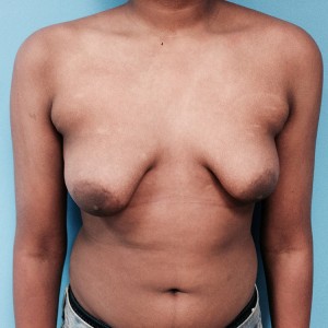 Male breast enlargement may occur soon after puberty as a result of the imbalance of estrogen and testosterone.