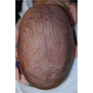 A baby with craniosynotosis in Long Island