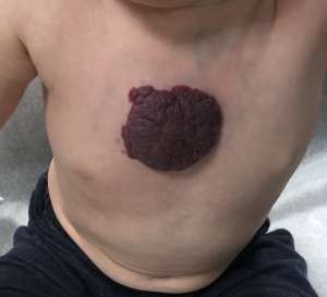 A hemangioma is formed by a stack of blood vessels on or just under the skin surface presenting at or right after birth.