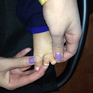 Dr. Bastidas has much experience in surgical reconstruction of webbed fingers & toes, resulting in patient satisfaction.