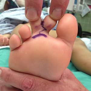 Dr. Bastidas has much experience in surgical reconstruction of webbed fingers & toes, resulting in patient satisfaction.