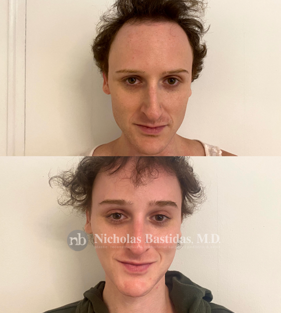 Facial Feminization Procedure Options