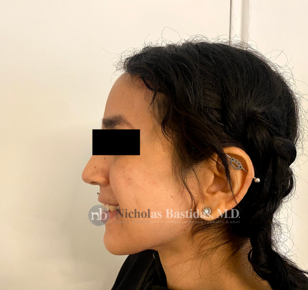 Facial Faminization