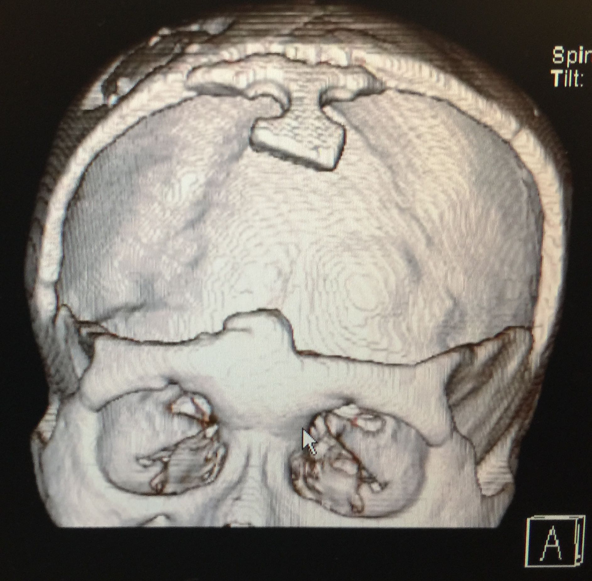 Craniosynostosis NY and Long Island