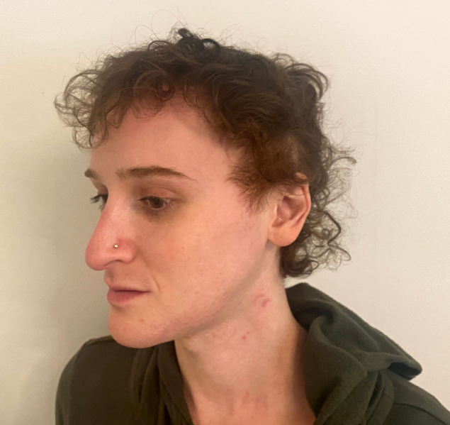 How Do I Pay For Facial Feminization Surgery