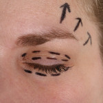 Aesthetic Eyebrow Surgery | Dr. Nicholas Bastidas, New York Craniofacial and Plastic Surgeon