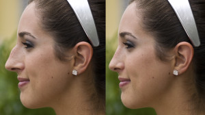 Rhinoplasty Surgery | Dr. Nicholas Bastidas, New York Craniofacial and Plastic Surgeon Rhinoplasty Surgery | Dr. Nicholas Bastidas, New York Craniofacial and Plastic Surgeon