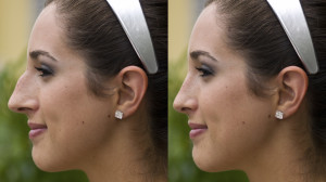 Rhinoplasty Surgery | Dr. Nicholas Bastidas, New York Craniofacial and Plastic Surgeon