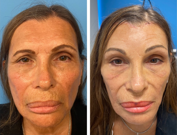 aging face cheeks