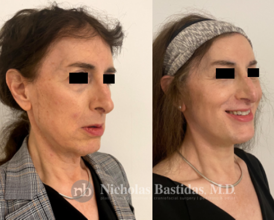 Facial Feminization Procedure Options